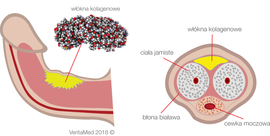choroba Peyroniego - kolagenaza.jpg